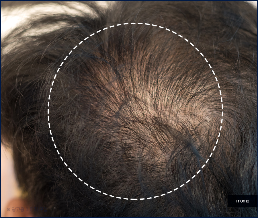 머리심기비용이 달라지는 이유와 차이점 관련 이미지 3