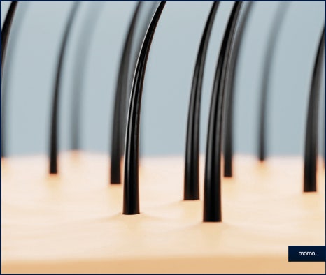 여자 정수리 탈모 모발이식 꼼꼼히 채우는 관련 이미지 6