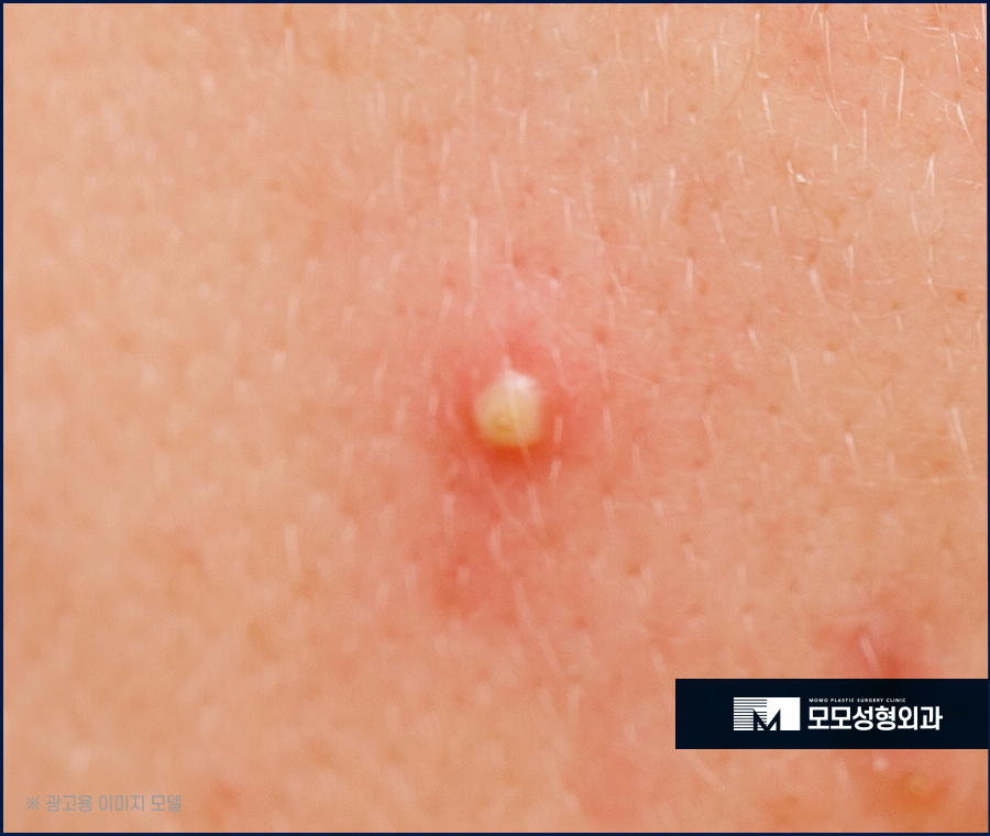 헤어라인좁쌀여드름 생성 원인과 해결법 관련 이미지 3