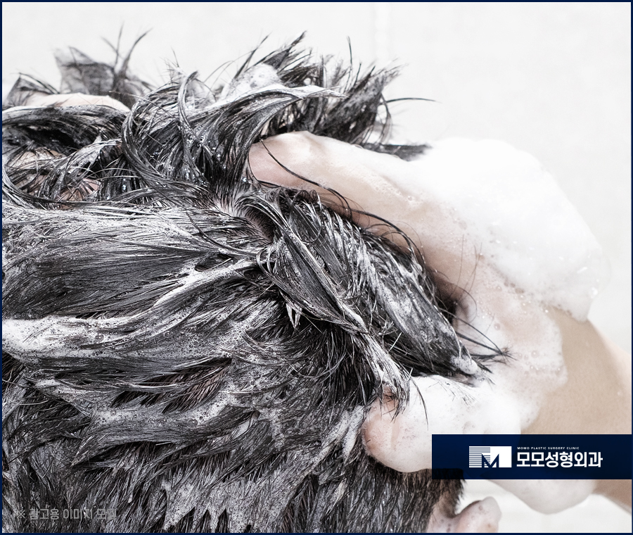 모발이식 6개월 차 변화와 유의할 점에 대해서 관련 이미지 9