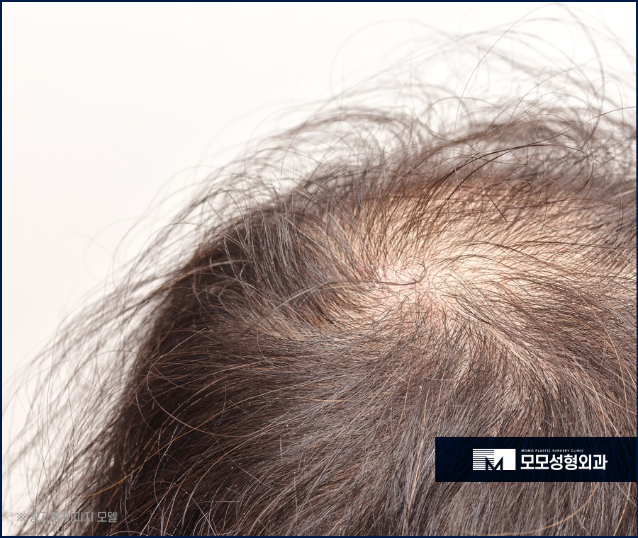 바르는탈모약 효과를 톡톡히 보길 원한다면 관련 이미지 3
