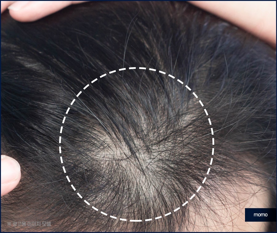 모발이식 생착률 극대화 하려면 관련 이미지 11