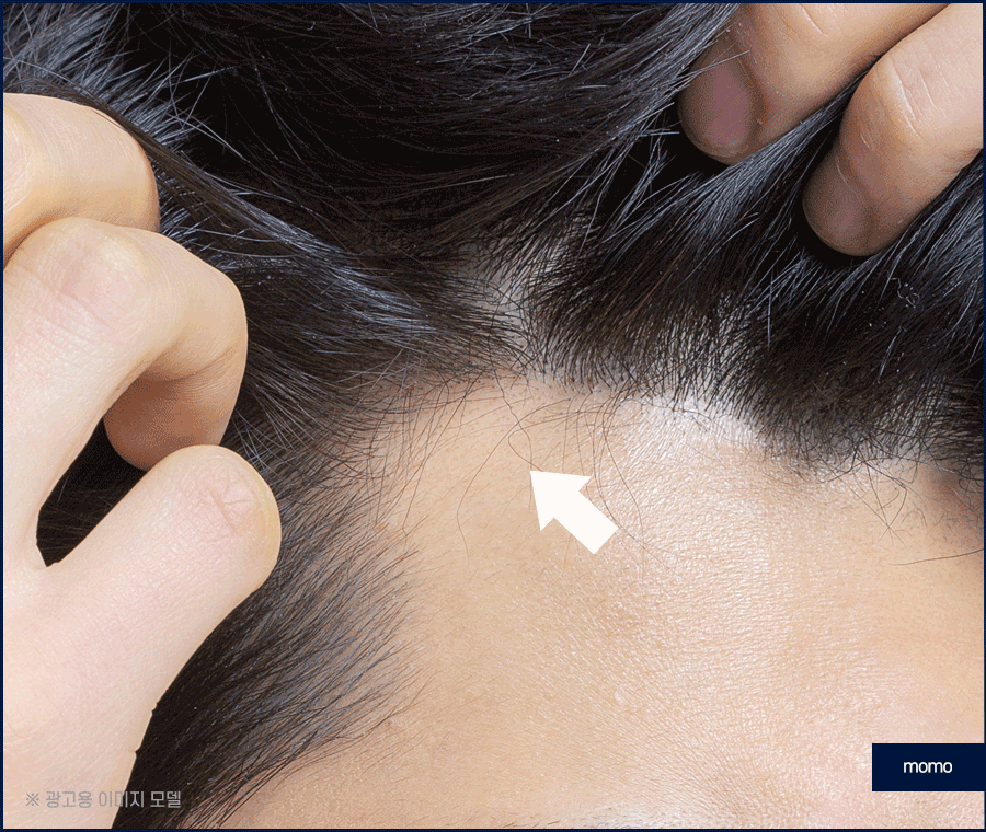 앞머리 모발이식 비용 개인에 따라 달라지는 이유 관련 이미지 9