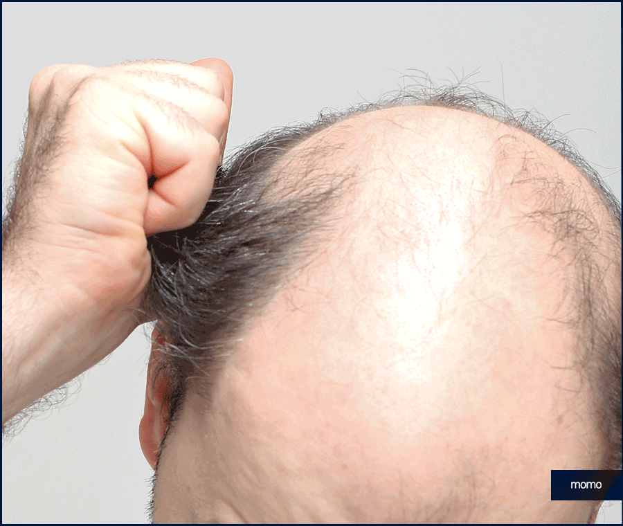 모발이식 금액 개인마다 차이가 나는 이유 관련 이미지 9