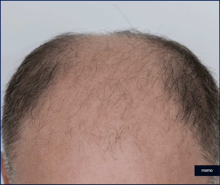 압구정 모발이식 세심한 사전 진단부터 시작하는 곳 관련 이미지 11