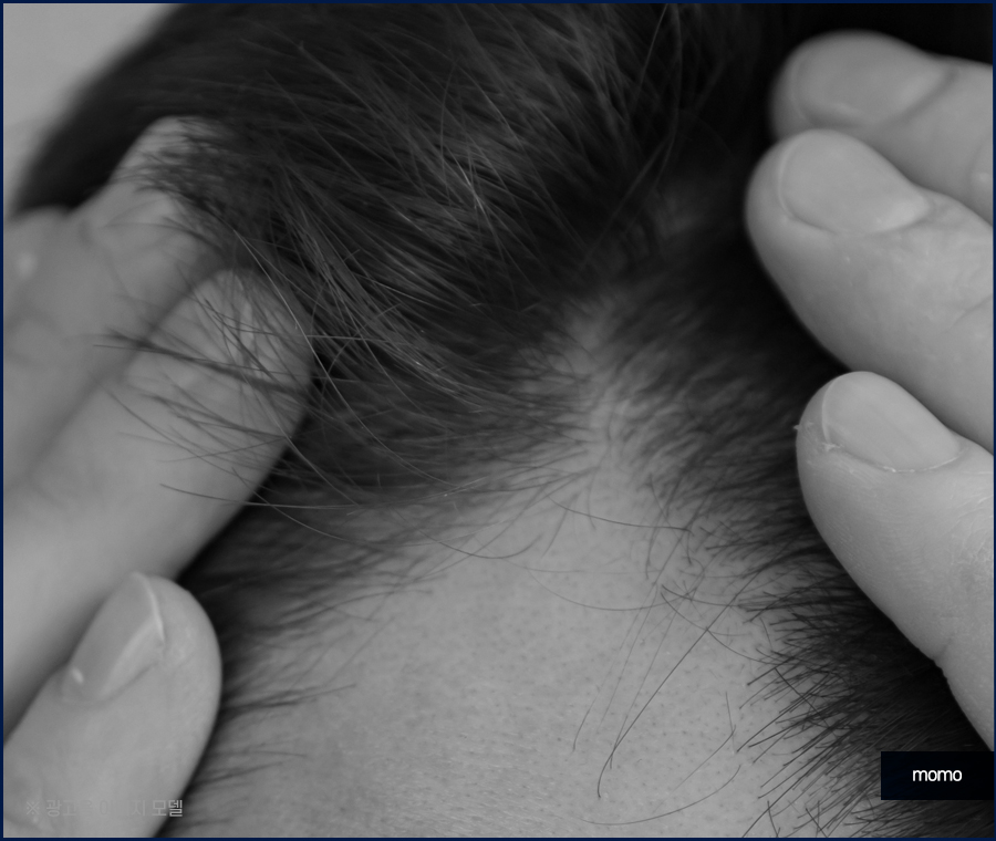 청소년 m자 탈모 요인 분석이 중요한 이유 관련 이미지 3