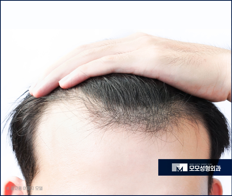 남자엠자탈모 극복을 위한 방향을 잘 잡아야만 관련 이미지 6