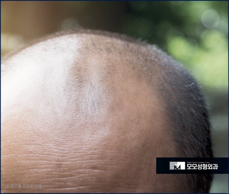 남자머리심기 신속한 일상 회복을 위한 방법 (ft. 비절개모발이식) 관련 이미지 4