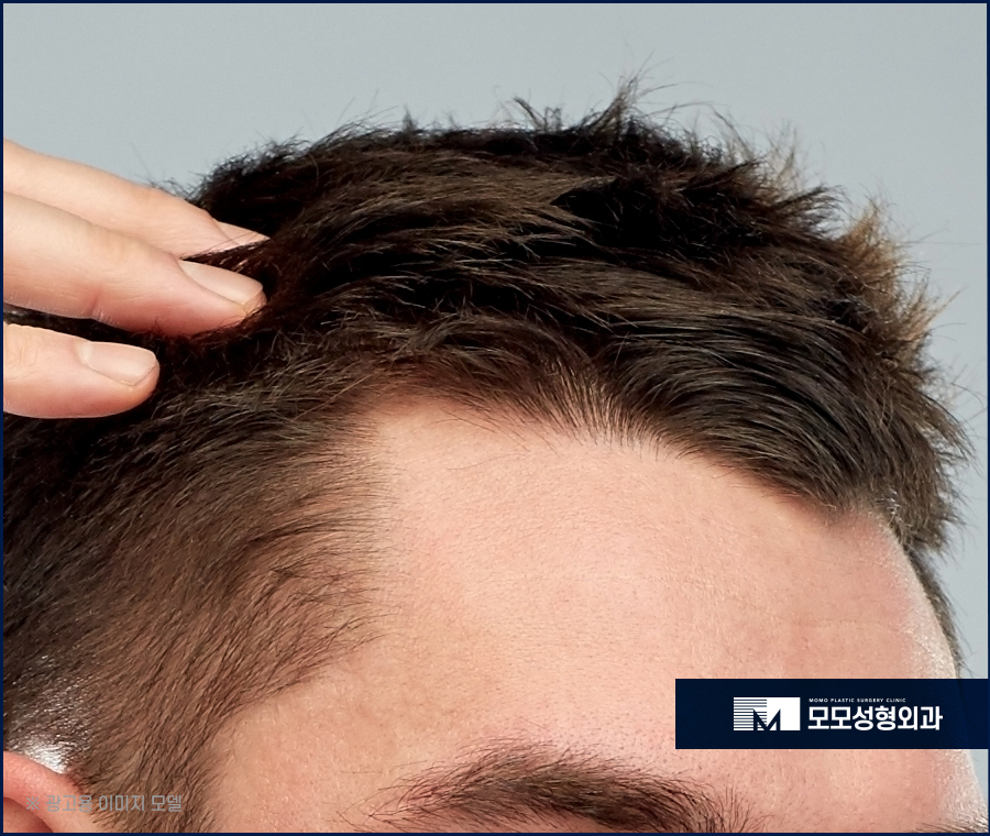 M자모발이식비용이 달라지는 기준과 방식의 차이에 대해 관련 이미지 3