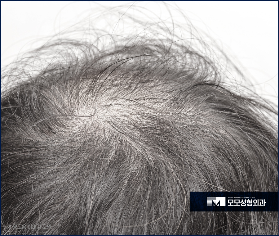 머리숱없는남자 커버가 아닌 보강을 원한다면 관련 이미지 3