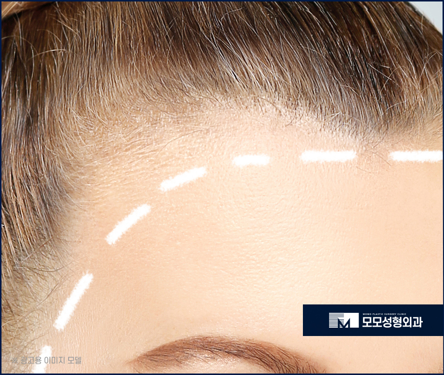 이마축소술 자연스럽게 채워가고 싶다면 관련 이미지 4
