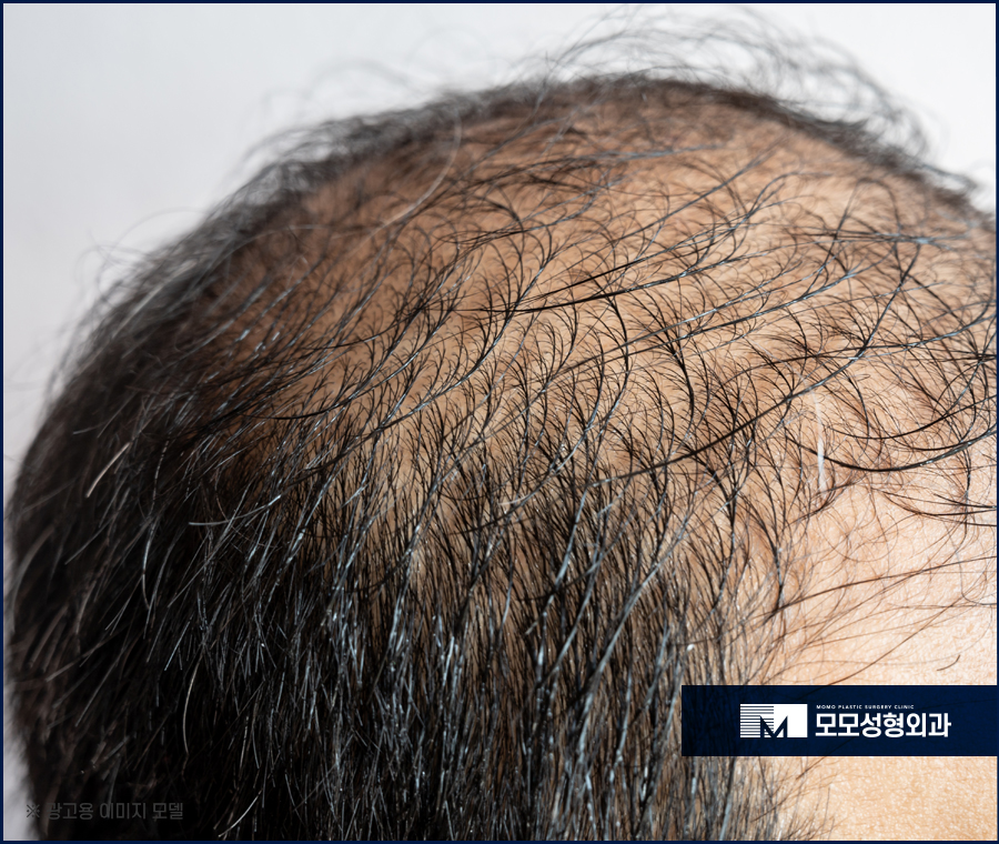 모발이식생착기간 기준에 대해서 관련 이미지 2