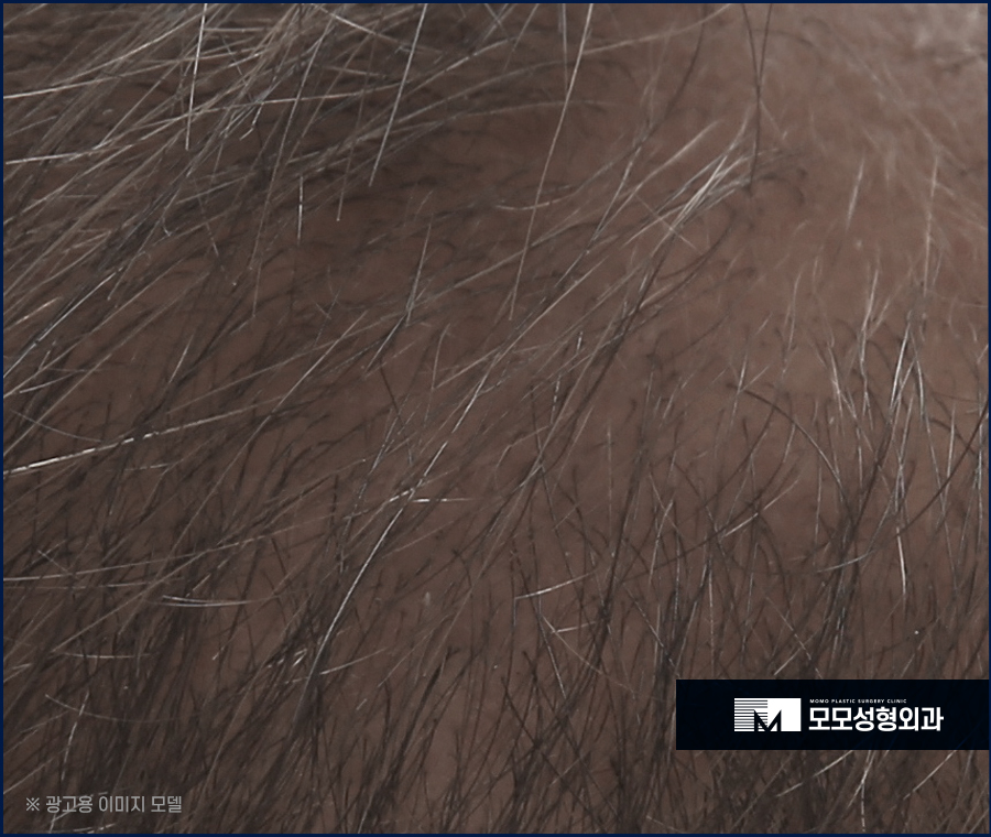체모 이식 부위별 특성 고려해서 자연스런 결과로 관련 이미지 2