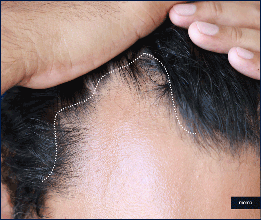 압구정 탈모병원 보완을 위한 최선책은? 관련 이미지 12