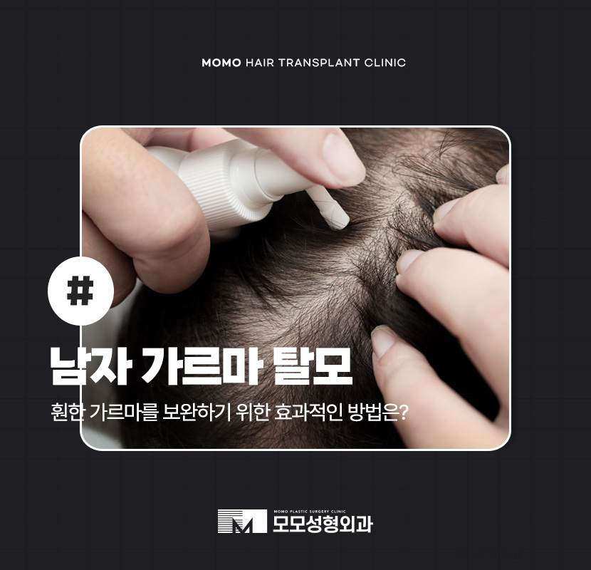 남자 가르마 탈모 고민을 끝내기 위한 방안은 관련 이미지 1