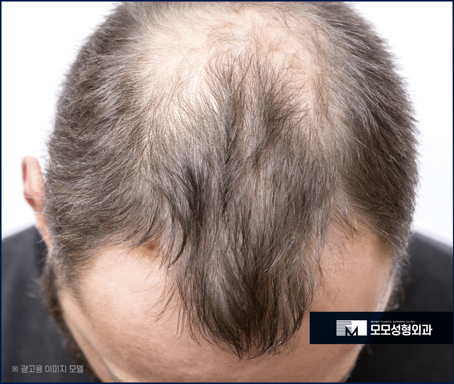 엠자이마모발이식 자연스럽게 채워지는 관련 이미지 5