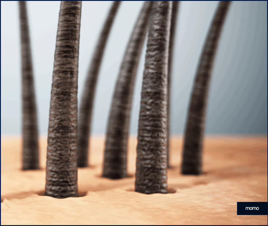 모발이식 3000모 비용 차이나는 이유 및 방법 관련 이미지 2