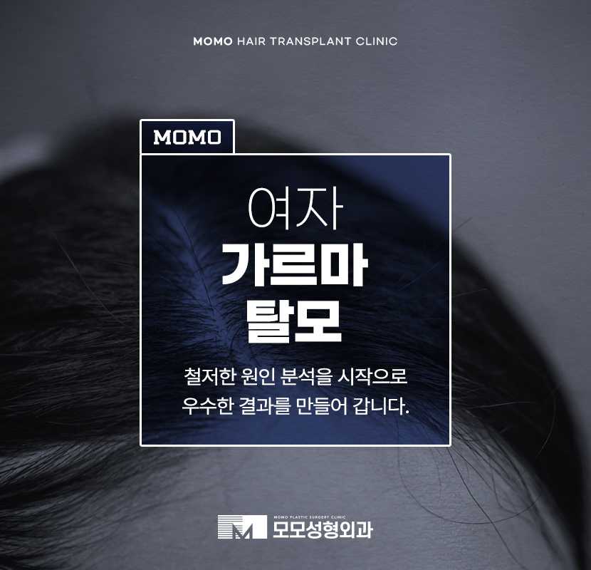 여자 가르마 탈모 모발이식으로 효과보려면? 관련 이미지 1