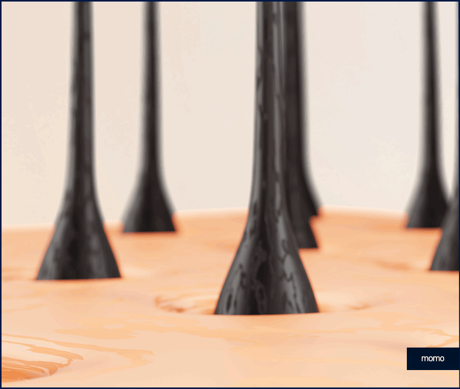 압구정 모발이식 세심한 사전 진단부터 시작하는 곳 관련 이미지 7