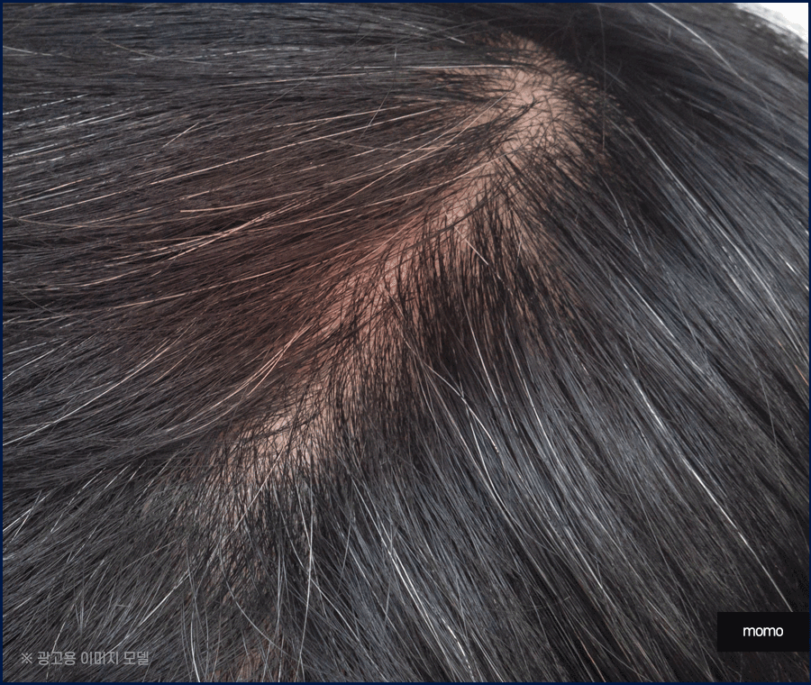 중학생탈모 발생 원인 및 보완하는 방법은? 관련 이미지 7