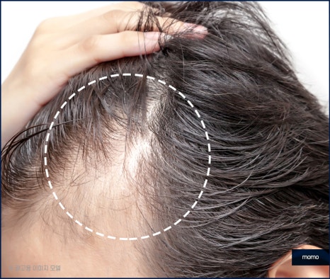 모발이식 후기 비교하며 섬세한 분석까지 해야만 관련 이미지 2