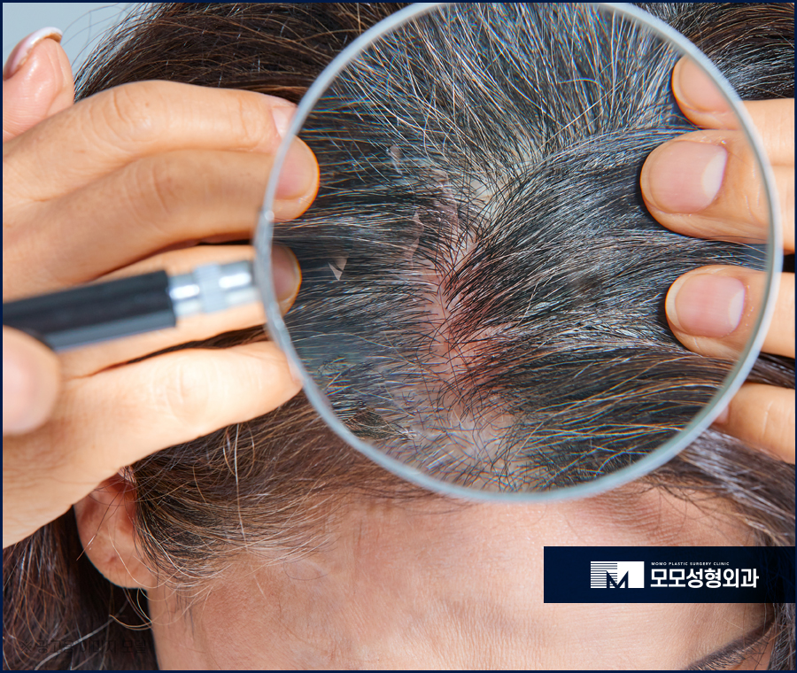 지루성두피염증상 어떤 것들이 있는지 관련 이미지 9