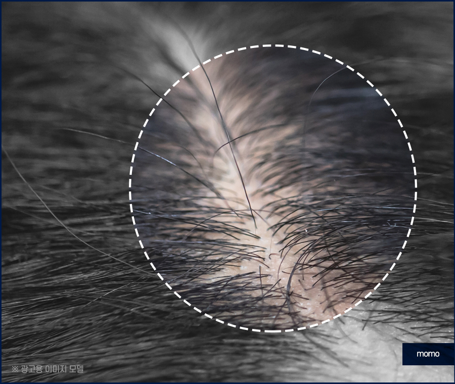 남자 가르마 탈모 고민을 끝내기 위한 방안은 관련 이미지 4