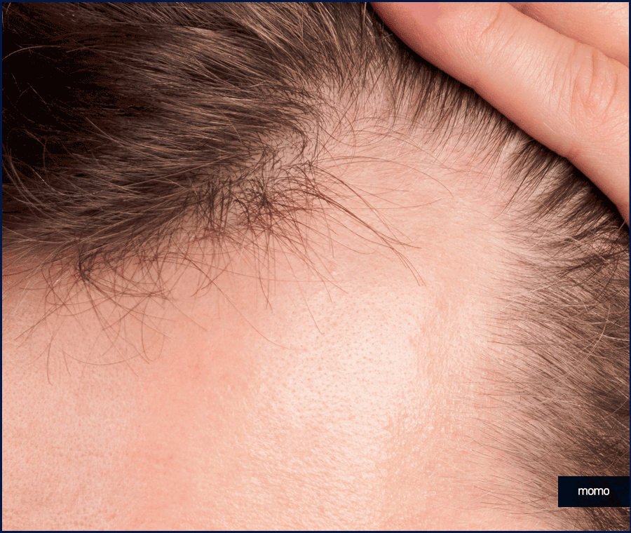 모발이식 금액 개인마다 차이가 나는 이유 관련 이미지 12