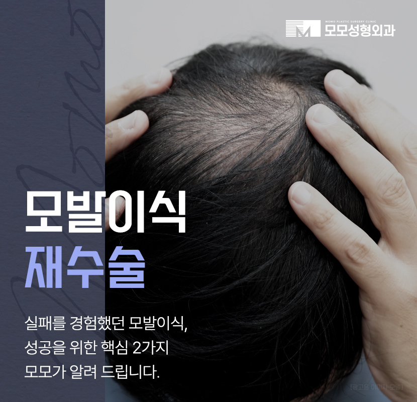 모발이식재수술 원인 및 성공을 위한 핵심 2가지 관련 이미지 1