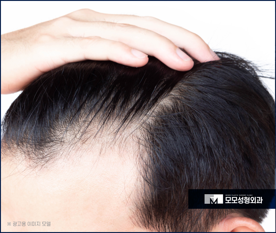 모발이식리터치 여부를 꼭 확인해야 합니다 관련 이미지 3
