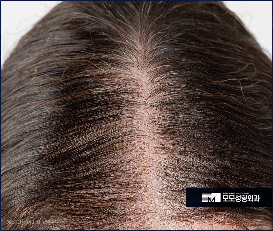 가르마모발이식 하얗게 보이던 부분을 채워서 관련 이미지 3