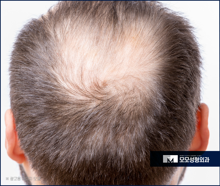 모발이식병원추천 중요한 기준에 대해 관련 이미지 3