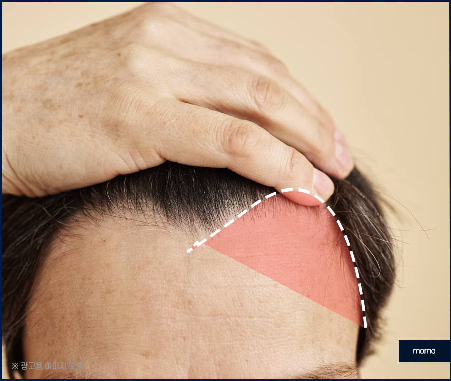 헤어라인모발이식비용 생착률을 높여가면서 관련 이미지 10
