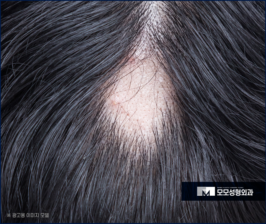 원형탈모 초기 타이밍을 놓치지 말고 대응해야 하는 이유 관련 이미지 3