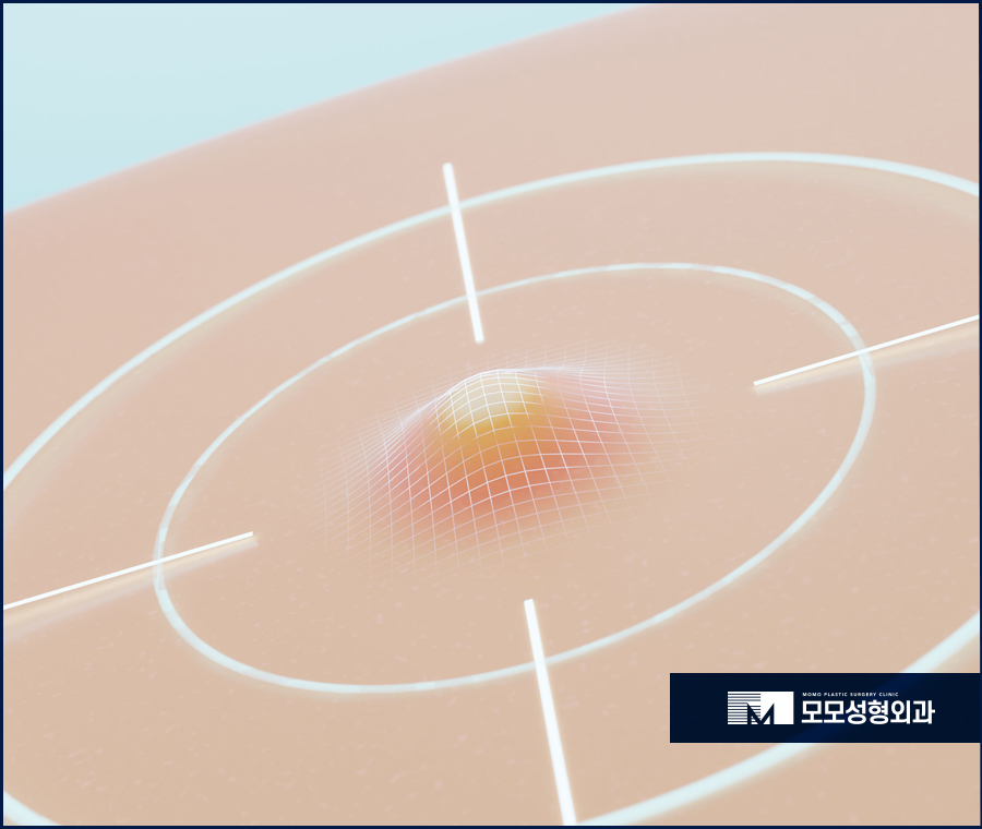 두피 피지낭종으로 인해 발생할 수 있는 문제들 관련 이미지 5