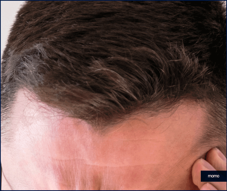 엠자탈모 약 진단과 처방으로 효과보기 위한 관련 이미지 8