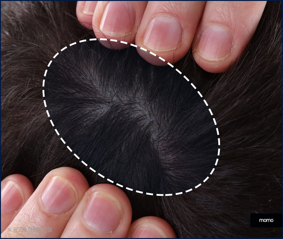 남자 가르마 탈모 진짜 내 머리처럼 채우려면 관련 이미지 9