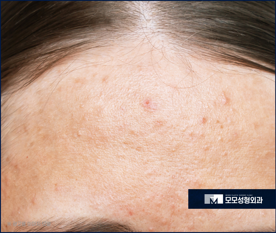 여자넓은이마 고민으로 부터 벗어나는 관련 이미지 5