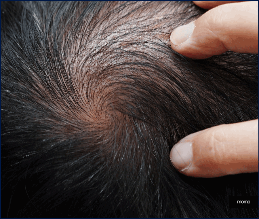 압구정 모발이식 병원 찾고 있다면 꼭 확인하세요 관련 이미지 2