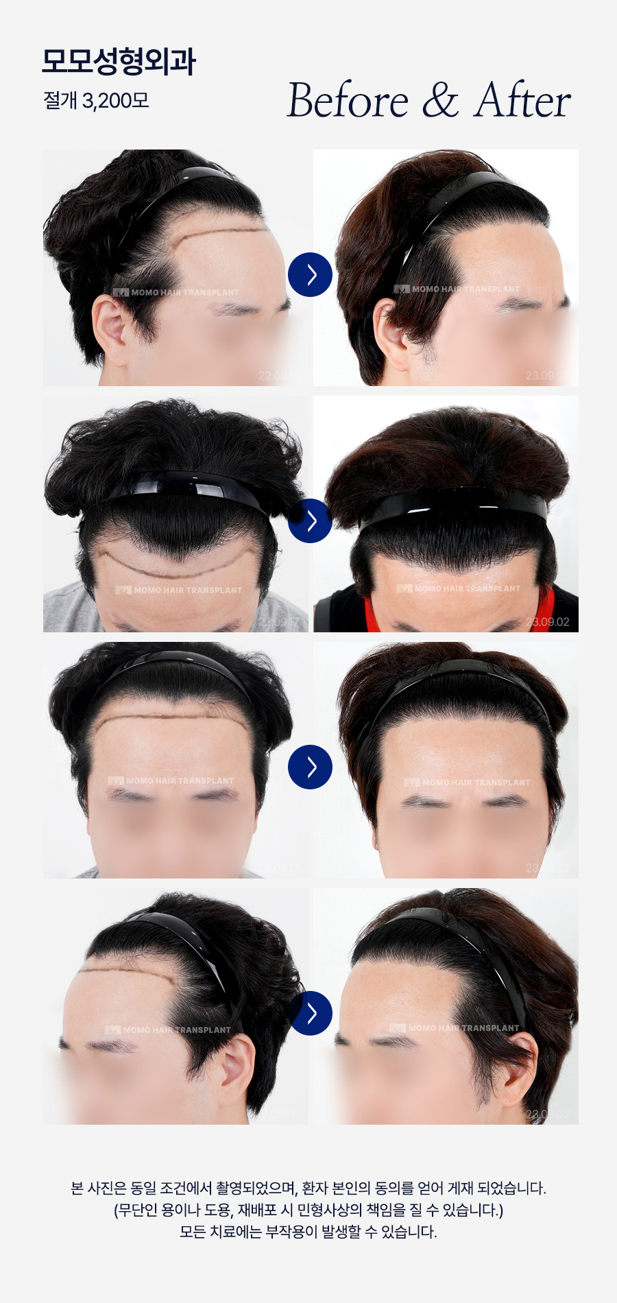 20대 모발이식 성공적인 결과를 위한 필수 조건 관련 이미지 15