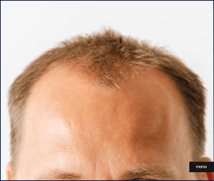 강남 모발이식 성공적인 변화를 만드는 꿀팁 관련 이미지 9