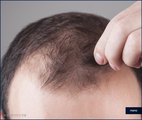 압구정역 모발이식 방법 및 생착률을 높이는 팁 관련 이미지 8