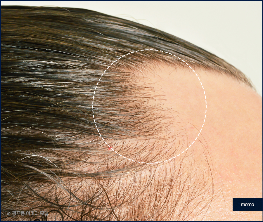 이마 머리 심기 넓은 모습을 보완하기 위한 관련 이미지 5