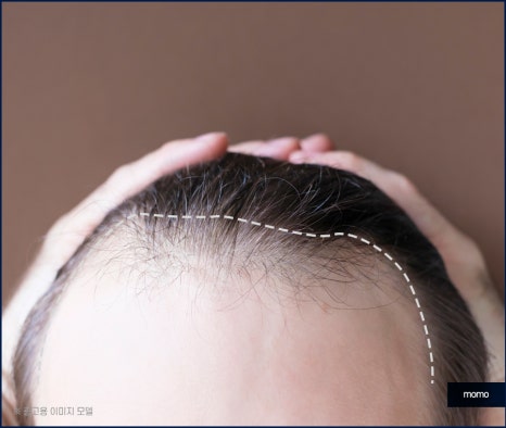 헤어라인 교정 비용 및 방법 디자인의 중요성 관련 이미지 8
