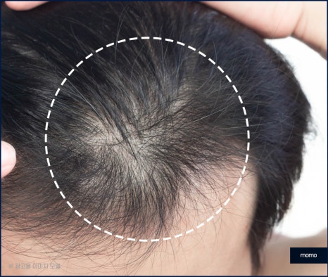 전두부탈모 원인과 시기, 해결 방안까지 관련 이미지 4