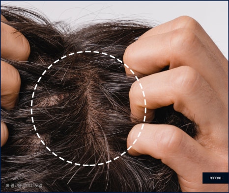 모발이식 후기 비교하며 섬세한 분석까지 해야만 관련 이미지 3