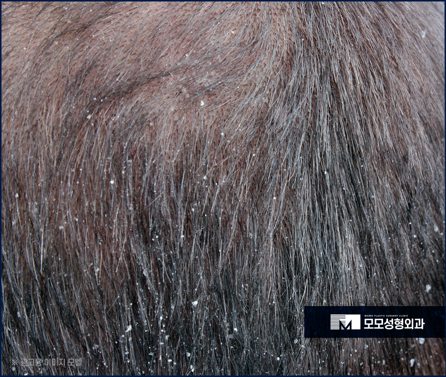 미녹시딜부작용 미리 알고 올바르게 관련 이미지 8