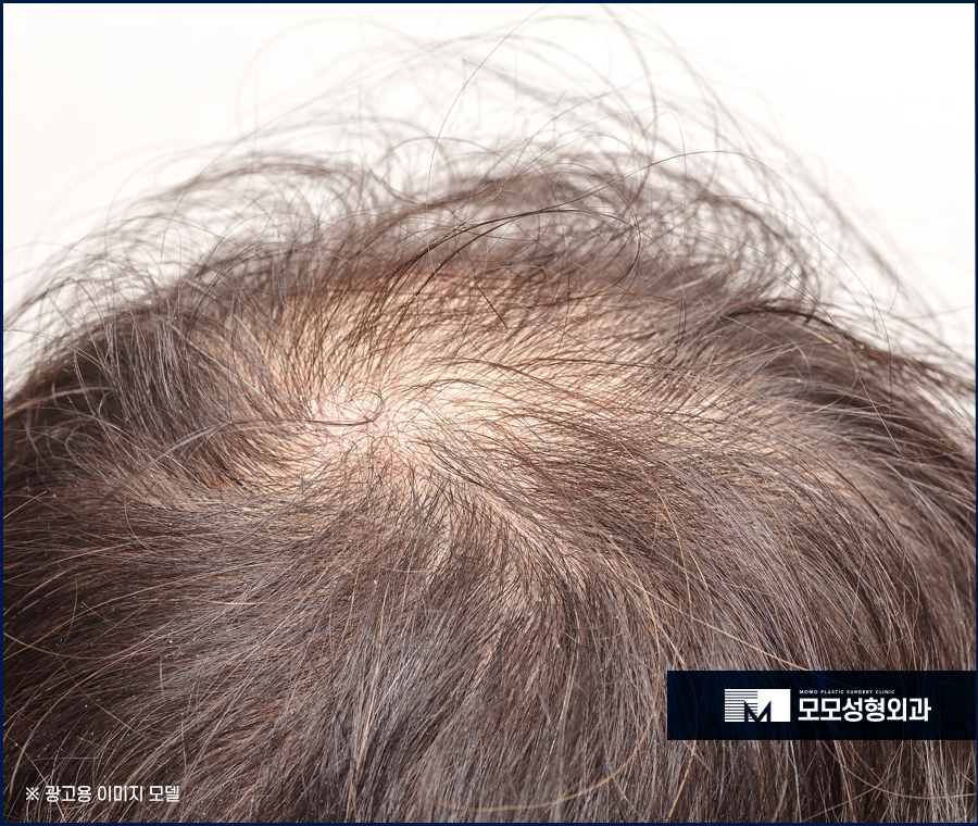 m자모발이식가격 결정을 못하고 있다면 관련 이미지 4