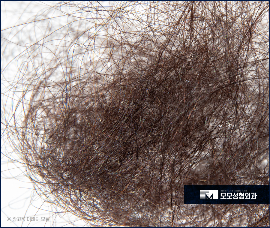 엠자탈모 초기 어떤 증상들이 동반될까요 관련 이미지 4