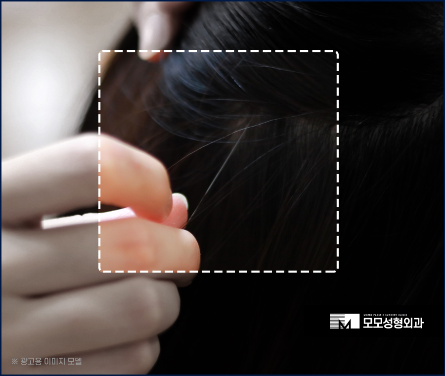 흰머리 간지러움 발생 요인부터 극복을 위해서는 관련 이미지 4